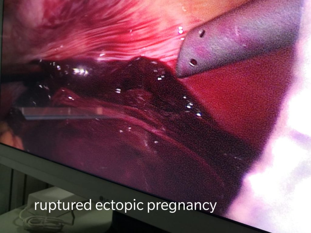 Ectopic pregnancy (tubal pregnancy) the facts! Dr. Ruchi Tandon