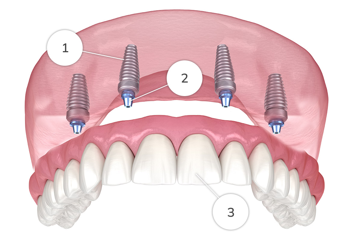 Fixed Implant Dentures in Fall River Dr. Ryan Thomas Dentistry