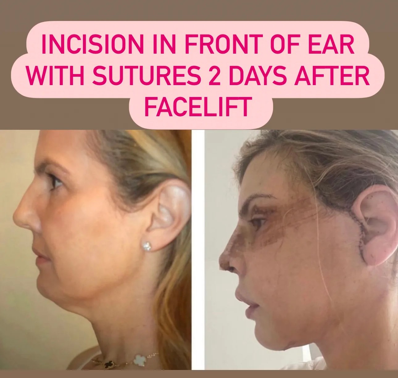 Facelift Scar Revision NYC Dr. Sam Rizk