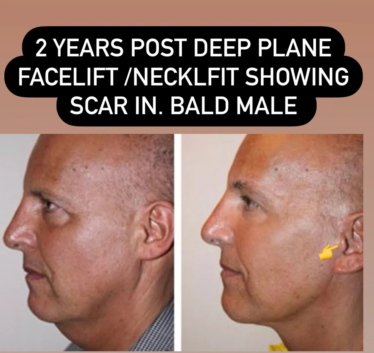 Facelift Scar Revision NYC Dr. Sam Rizk