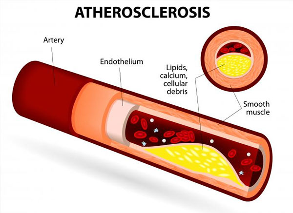 Scary Facts About Smoking and Clogged Arteries Dr. Sam