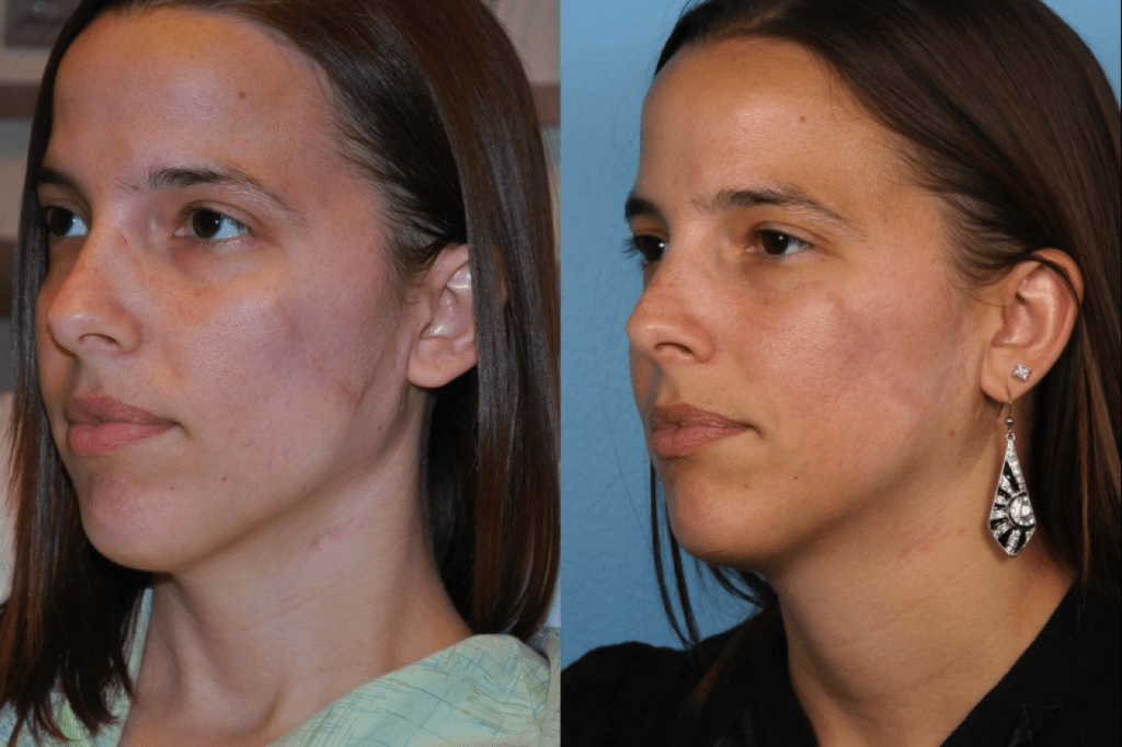 Scar Revision Northwestern Facial Plastic Surgery