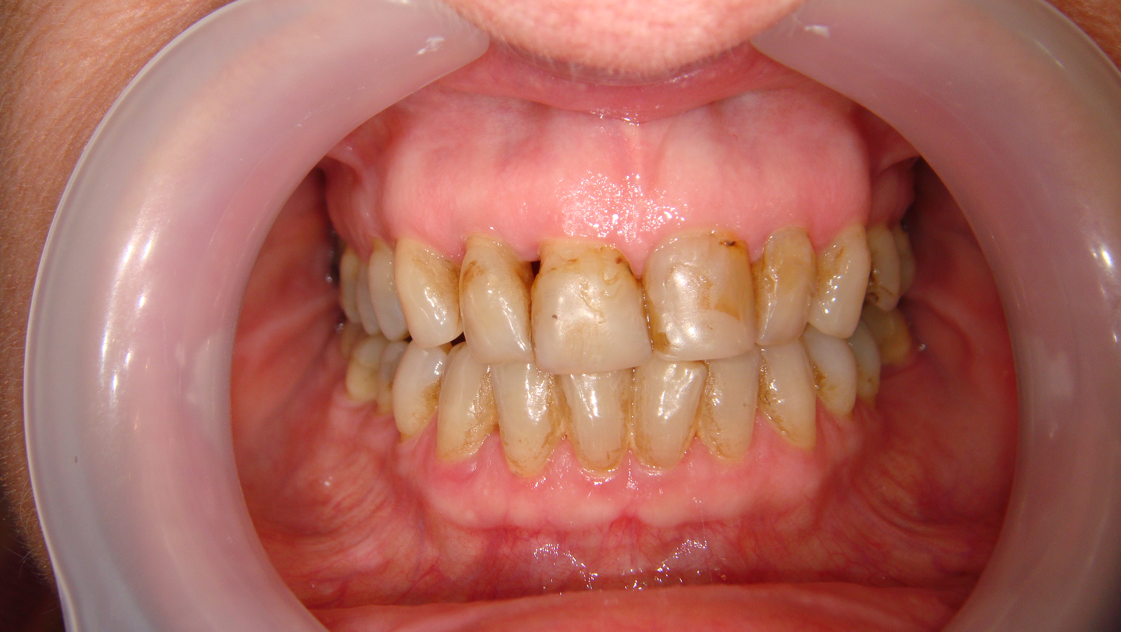 Before After Porcelain Veneer in Bangkok, Thailand at Dr. Sunil