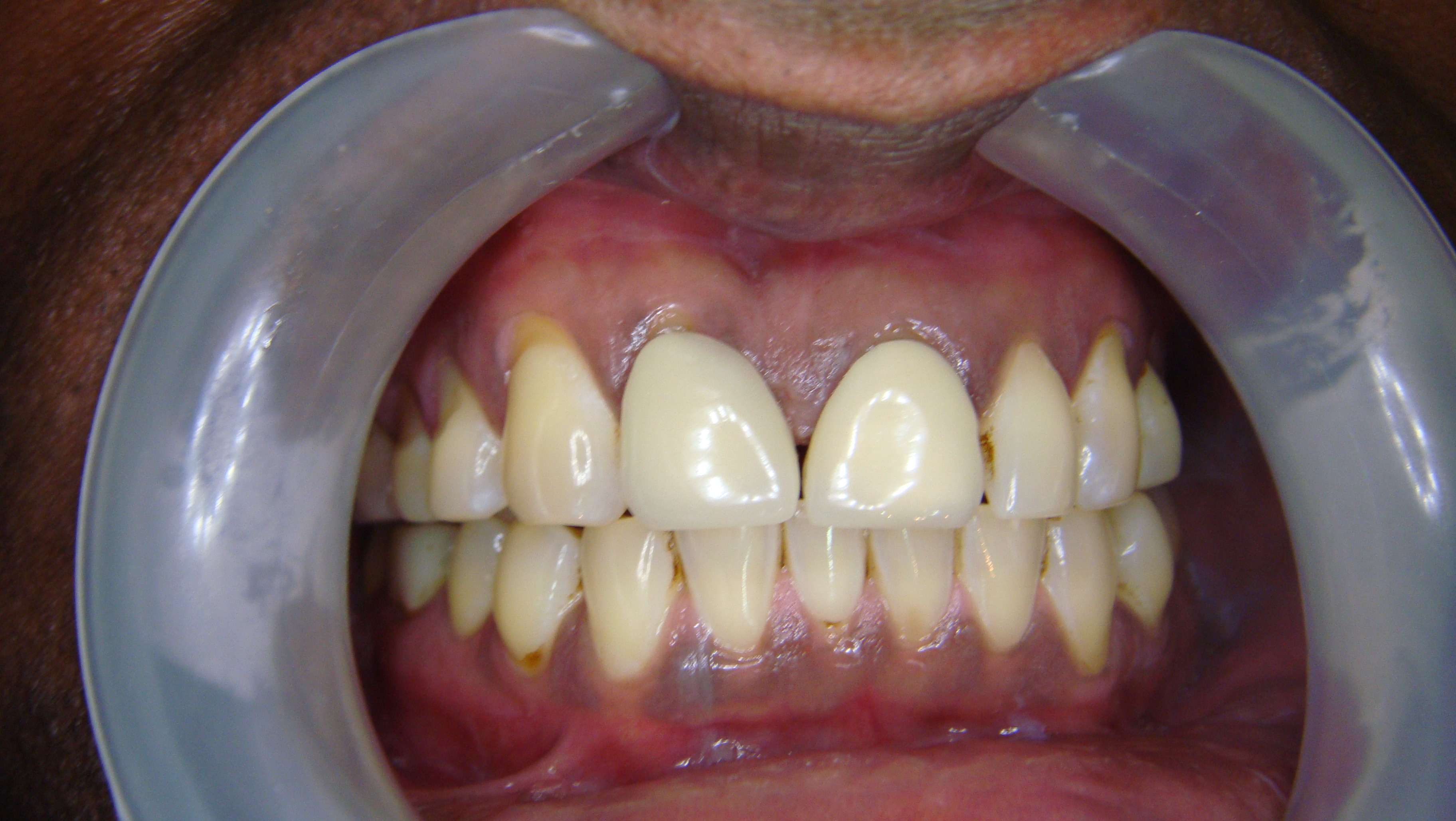 Before After Porcelain Veneer in Bangkok, Thailand at Dr. Sunil