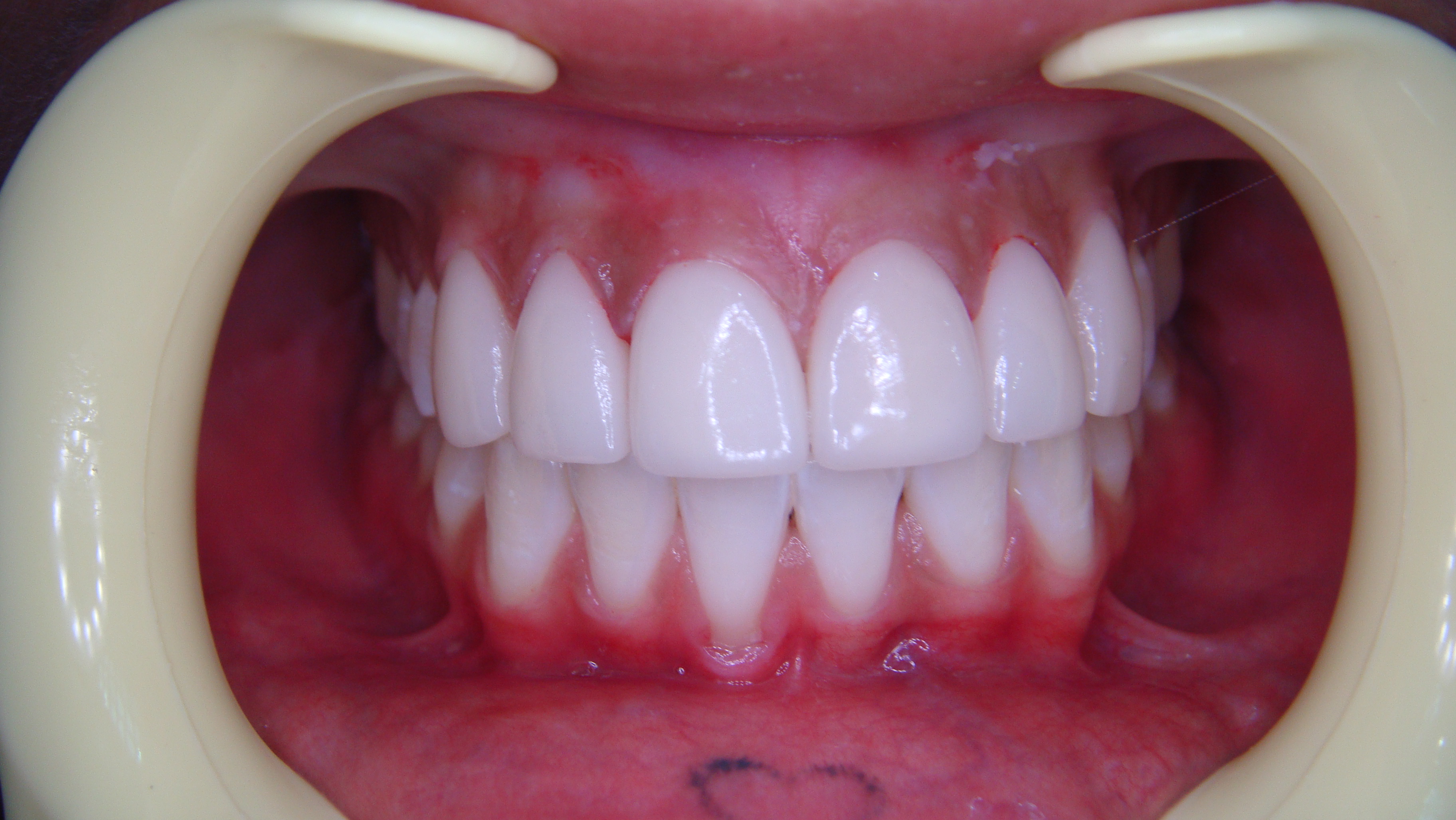 Before After Porcelain Veneer in Bangkok, Thailand at Dr. Sunil