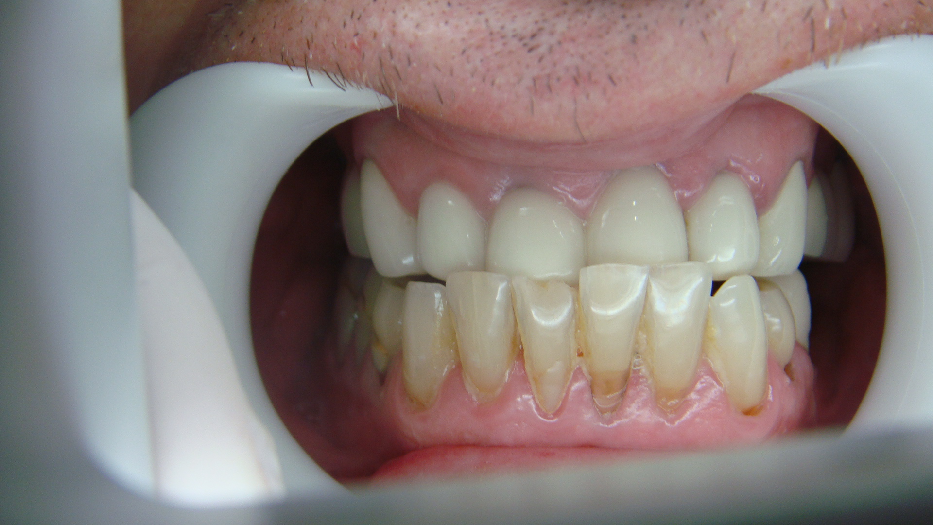 Before After Porcelain Crown / Bridges in Bangkok, Thailand at Dr. Sunil Dental Clinic