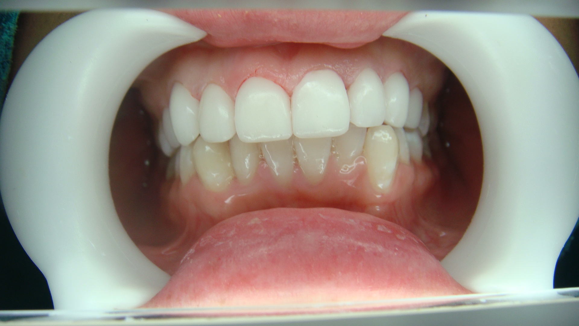 Before After Porcelain Veneer in Bangkok, Thailand at Dr. Sunil