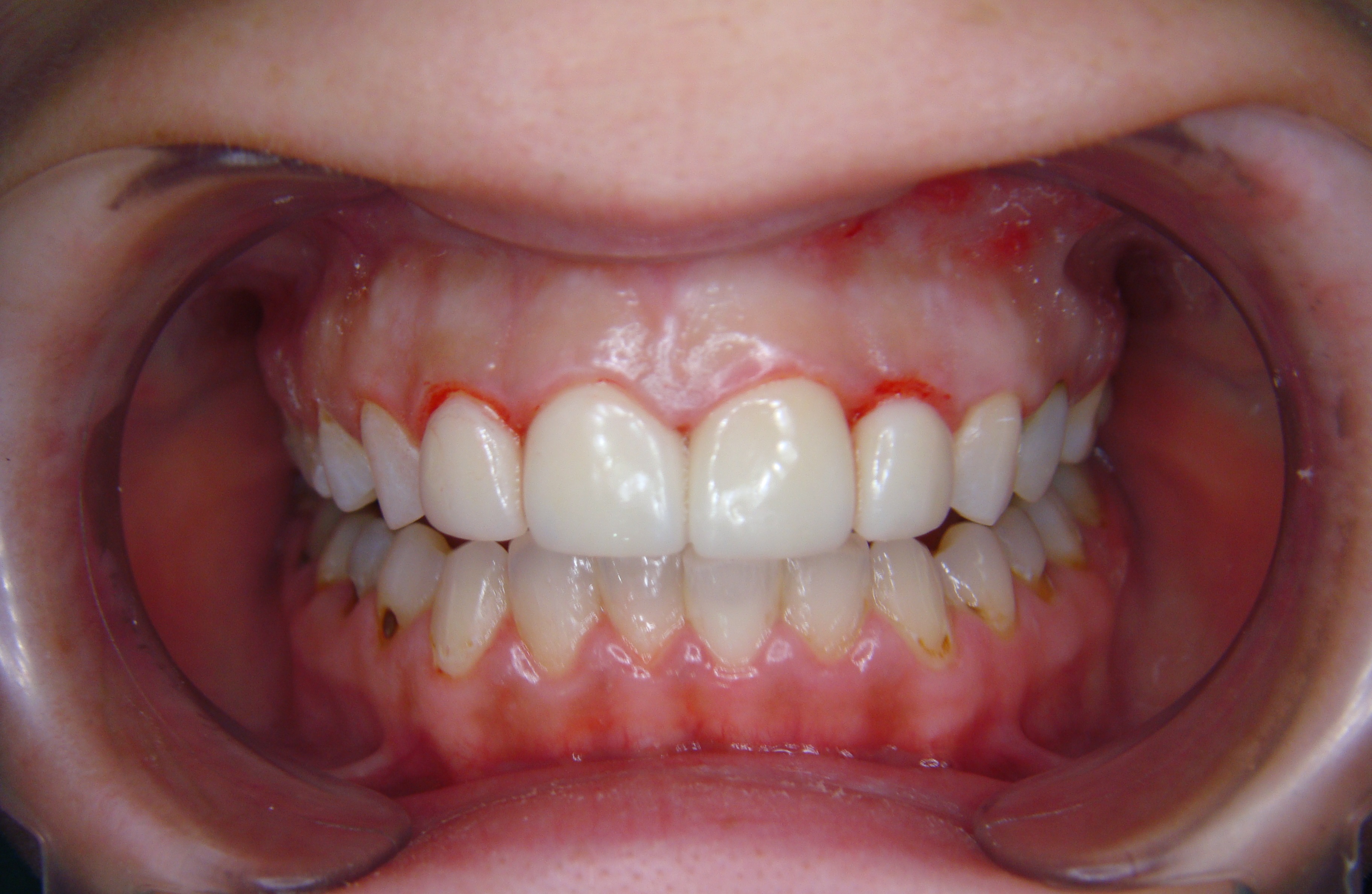 Before After Porcelain Veneer in Bangkok, Thailand at Dr. Sunil