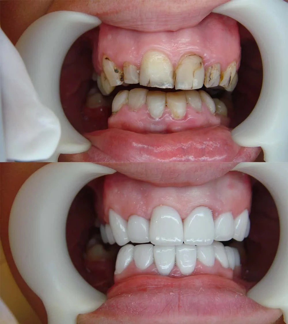 Dental Crowns Thailand Transform Your Smile Dr Sunil Dental