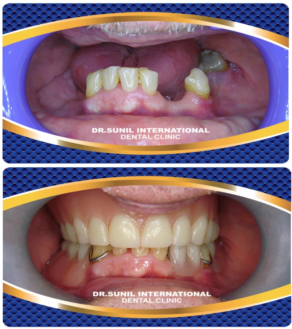 Dentures in Bangkok (Dr Sunil Dental Clinic)