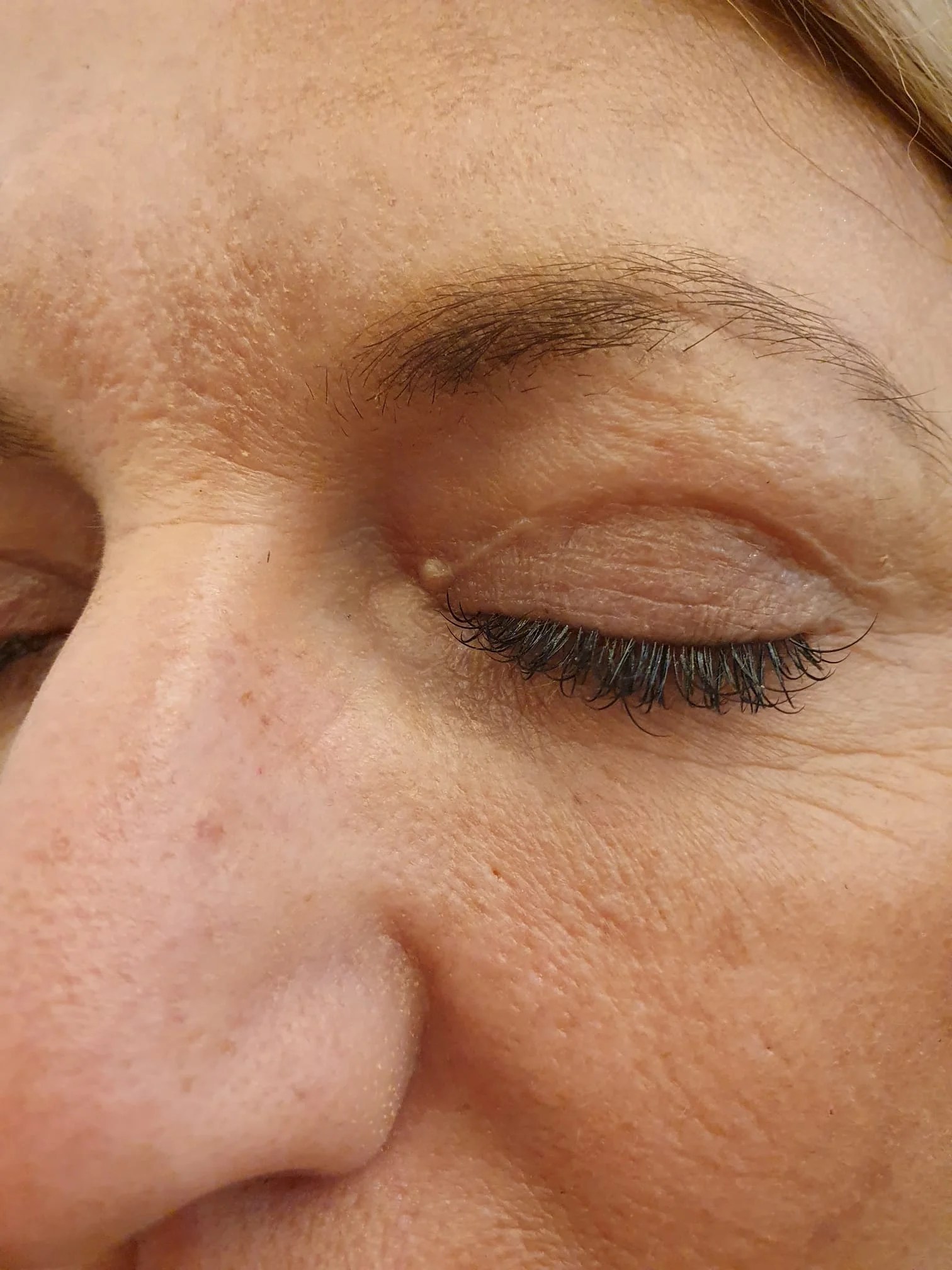 Lower Blepharoplasty Scars