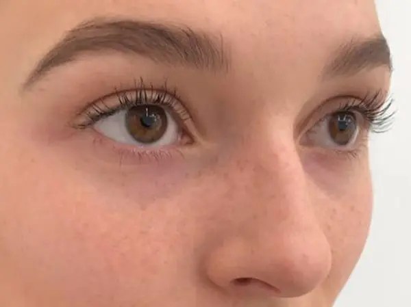 Tear Trough Dr Tatiana Lapa Harley St Aesthetic Specialists
