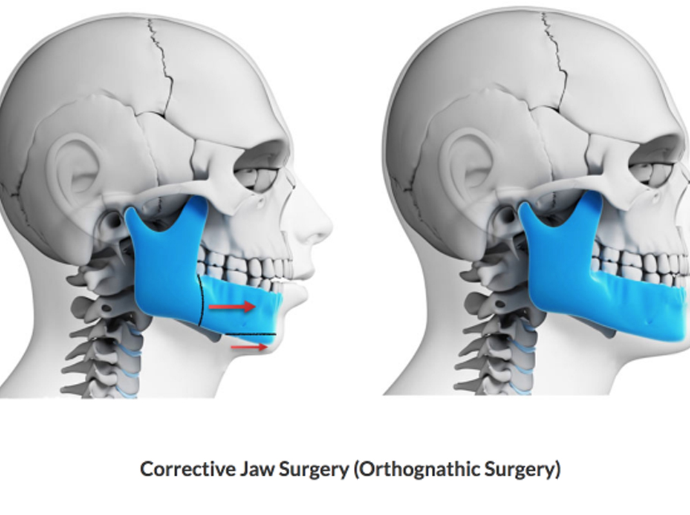 Orthognathic Jaw Surgery Dr. Thomas Arayathinal Maxillofacial Surgeon Corrective