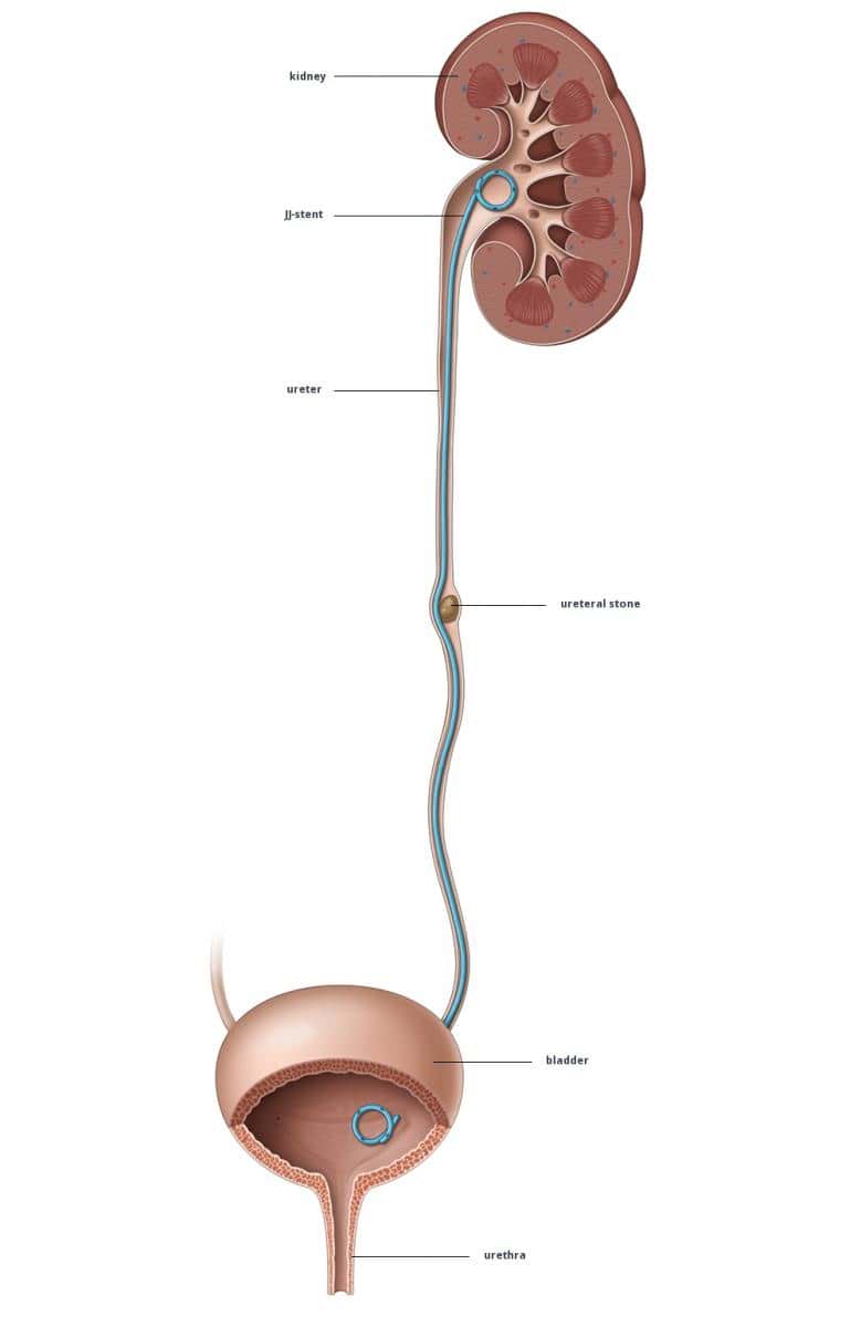 Dr Tim Nathan Urology Insertion and Removal of Ureteric Stents