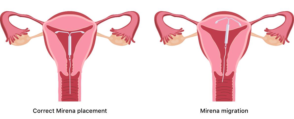 Light Bleeding With Mirena