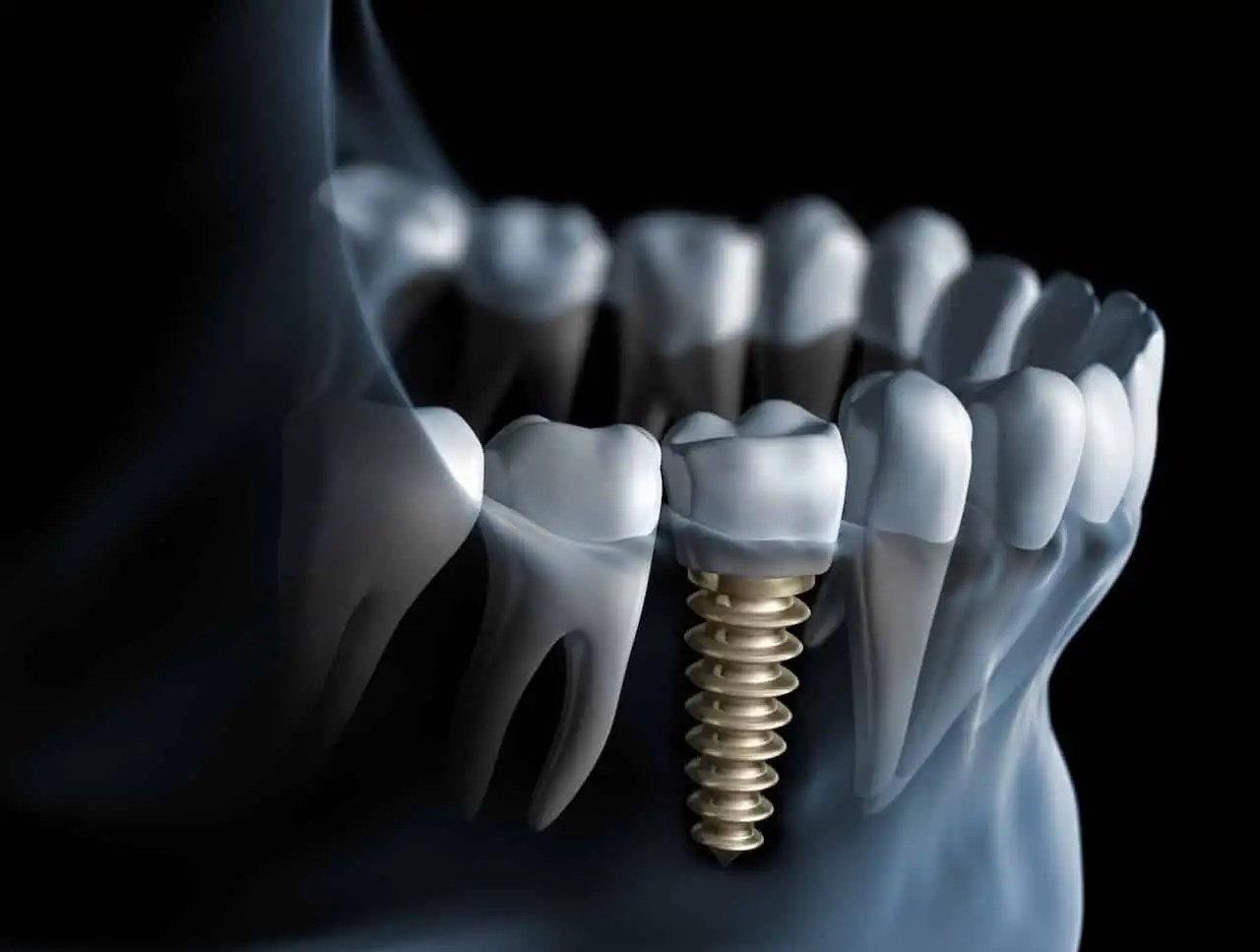 Implants San Francisco Dentist South San Francisco Dentist