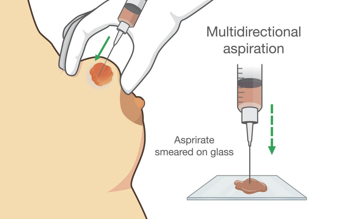 Breast Lump Differential Diagnosis And Treatment