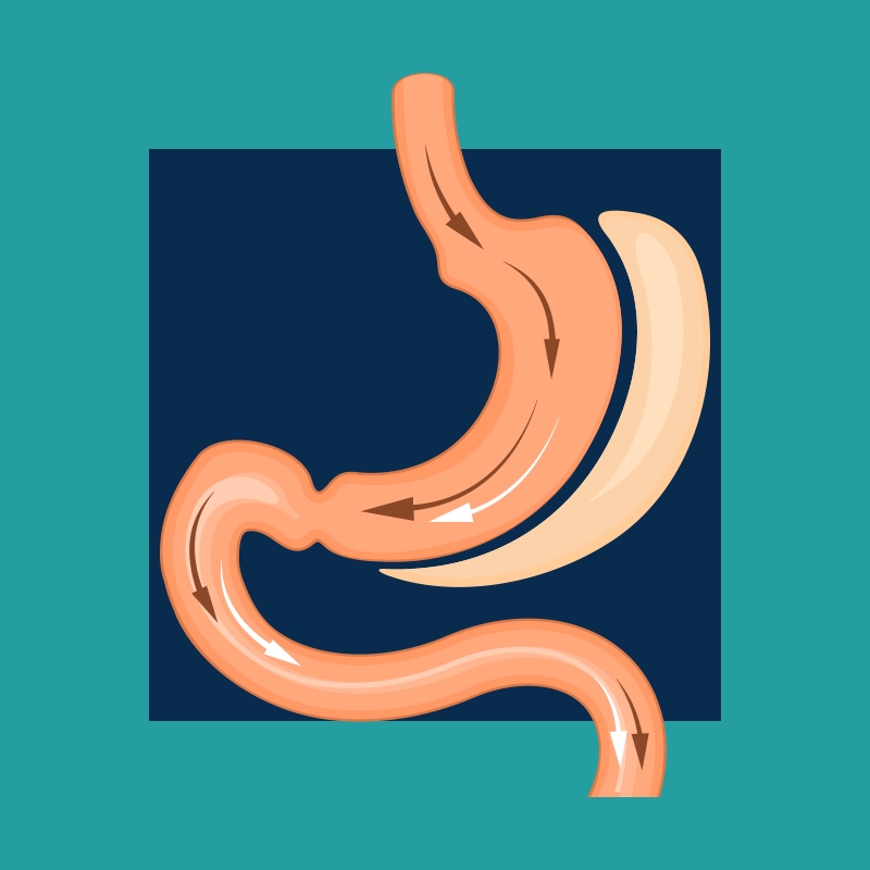 Gastric Sleeve dr wael shalaan the best Obesity surgeon in egypt