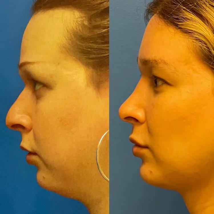 Facial Feminization Before and After Adam Bryce Weinfeld, MD, Board