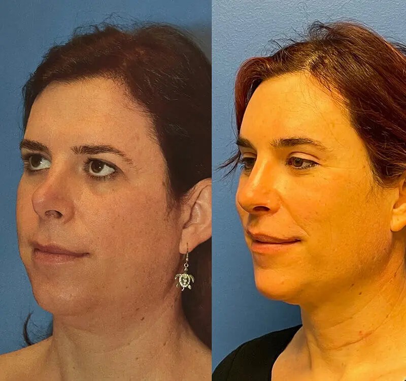 Facial Feminization Before and After Adam Bryce Weinfeld, MD, Board