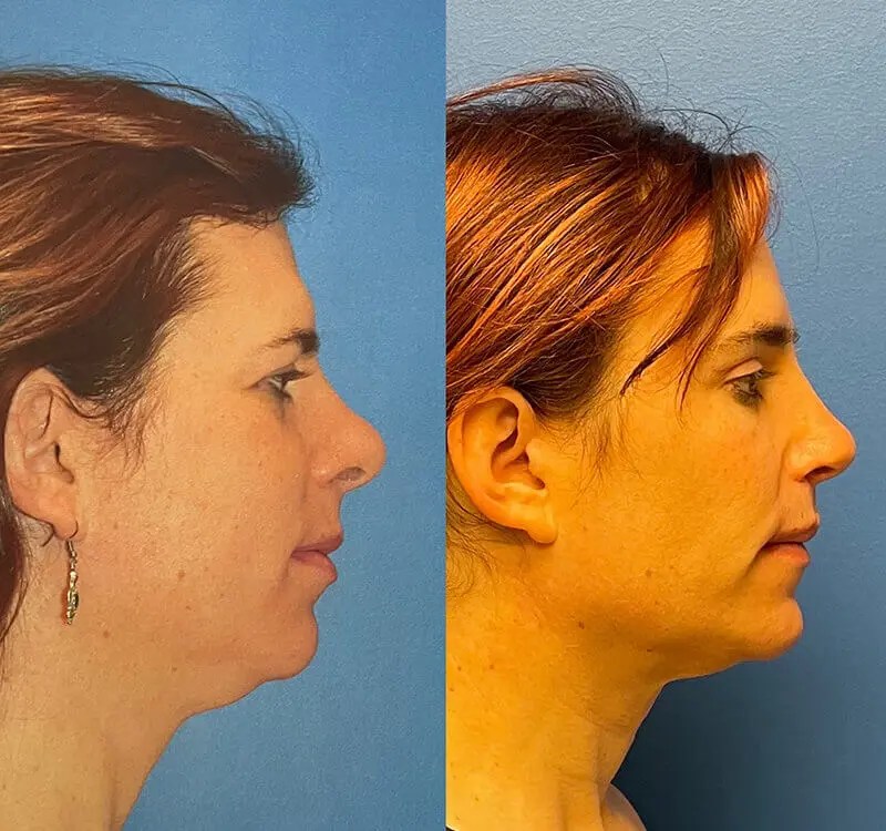 Facial Feminization Before and After Adam Bryce Weinfeld, MD, Board