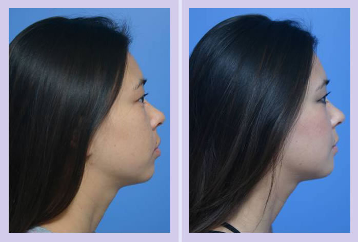 chin augmentation case 4 Anthony Youn, MD, FACS