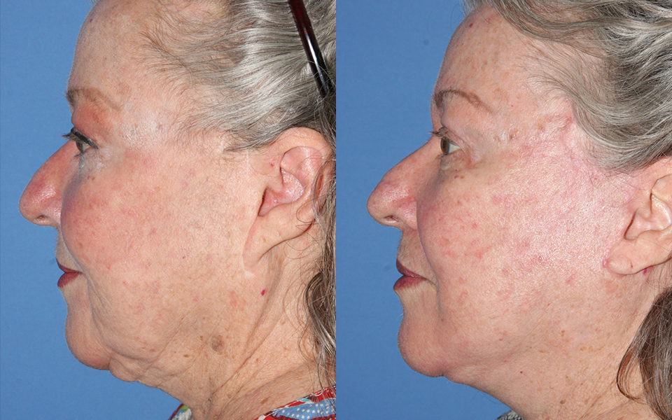 Facelift in San Antonio Facial Plastic Surgery Austin & San Antonio