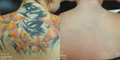 Rimozione Tatuaggi - Dr. Zanframundo - Dermatologo Bari 231_x_462_jpg