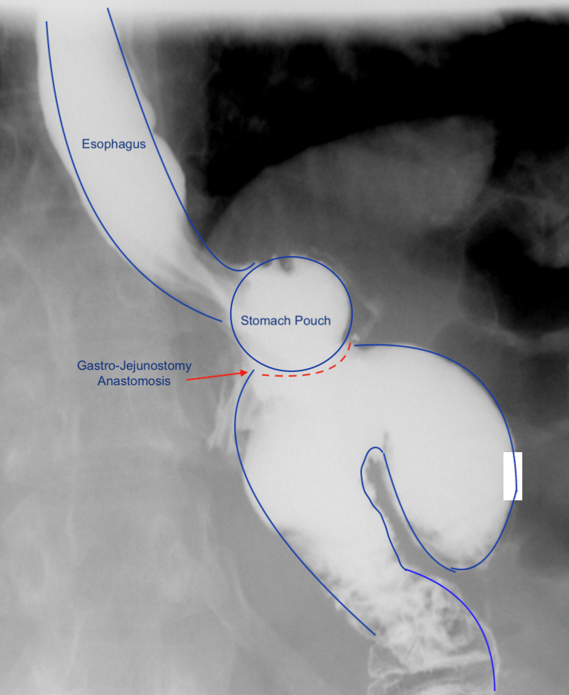 Upper Gastrointestinal Tract Diagram