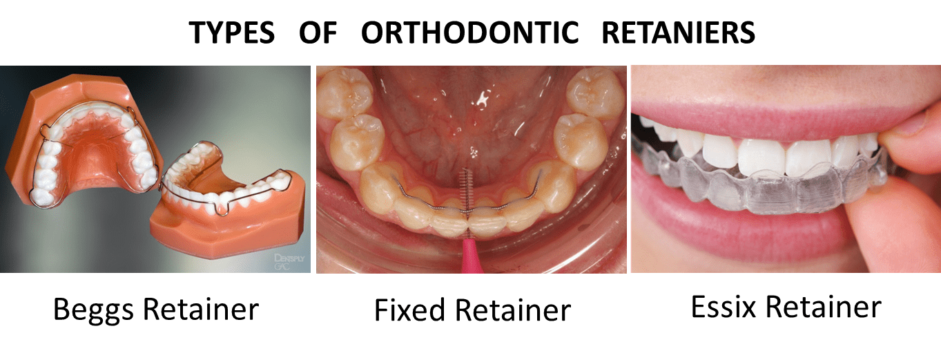 Orthodontic Retainers all you need to know DT Smile Care