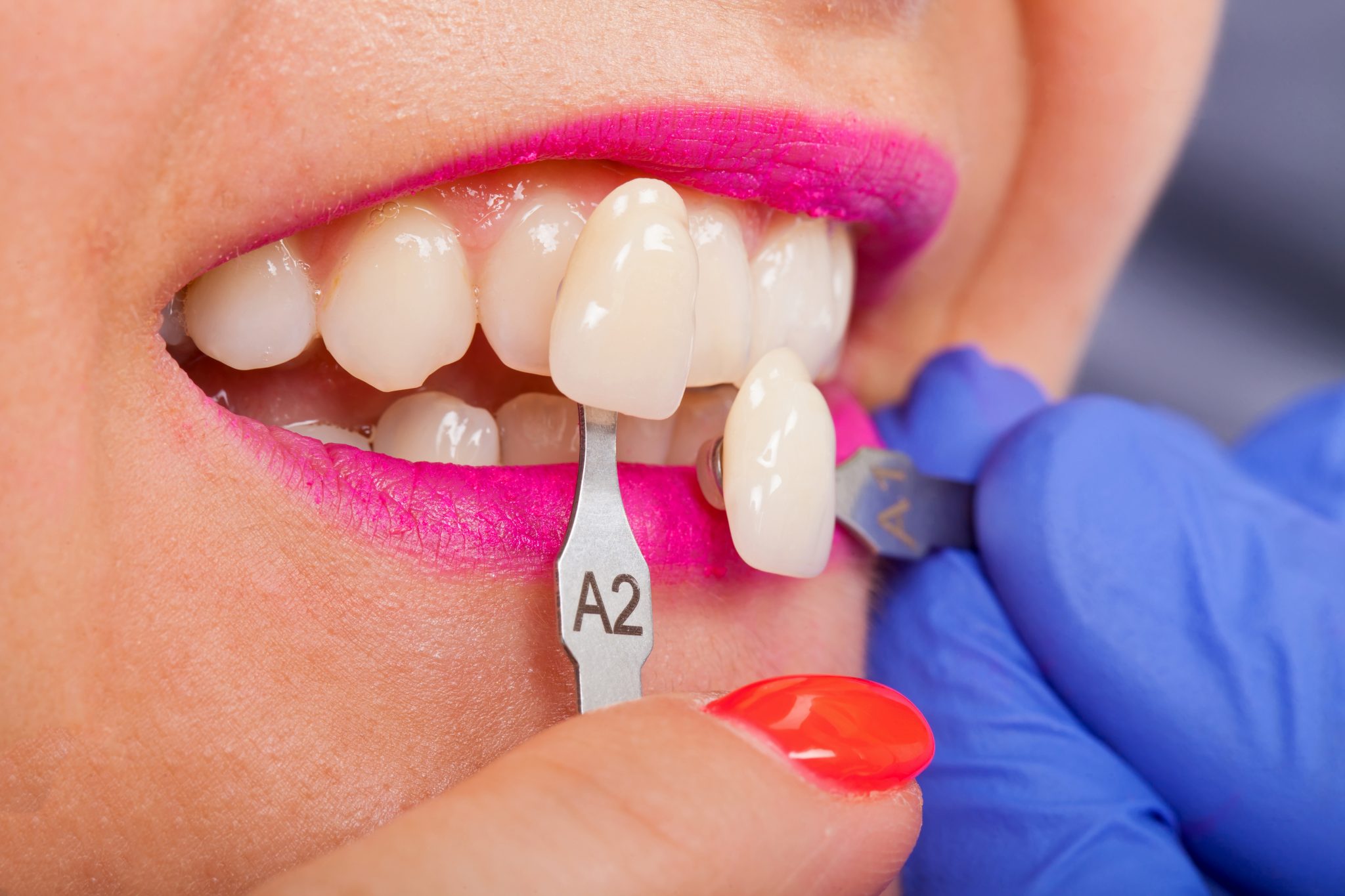 How long do Veneers last? Dr. Dulay & Associates