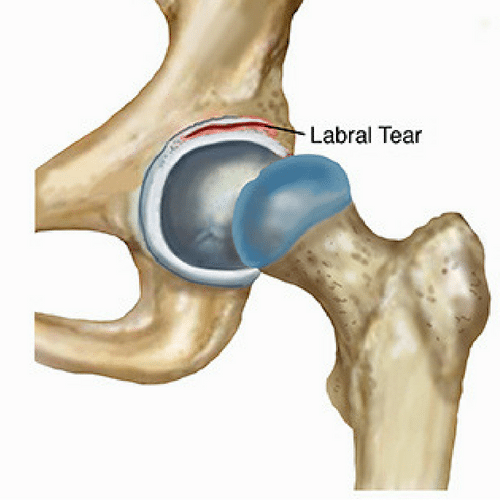 Our Guide to the Best Hip Brace in 2019 BestHealthGear