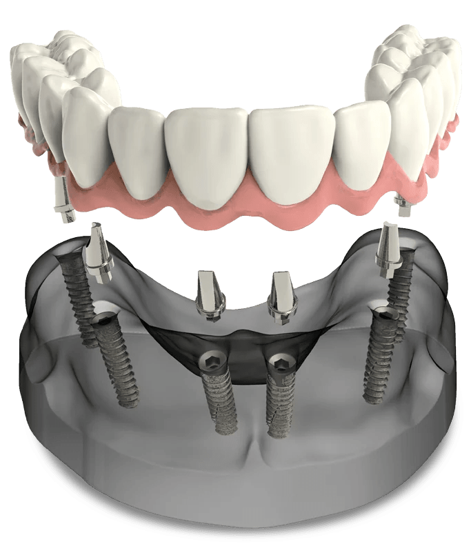 Full Arch Dental Implants Durham Dental Solutions