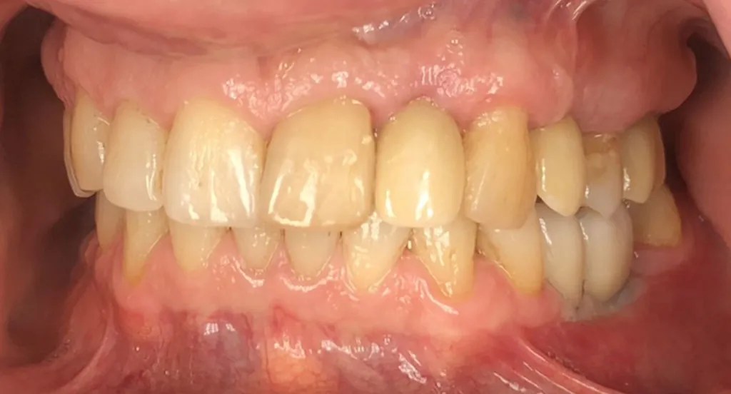 About Dental Implants Durham Dental Solutions