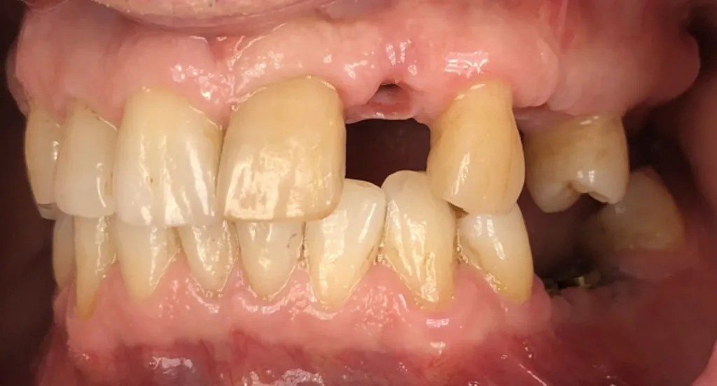 About Dental Implants Durham Dental Solutions