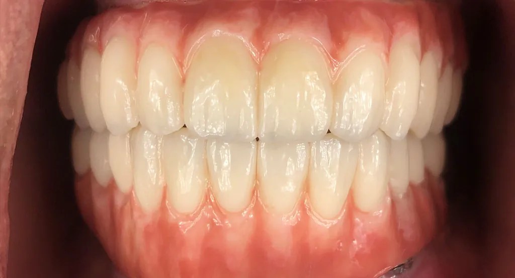 Full Arch Dental Implants Durham Dental Solutions