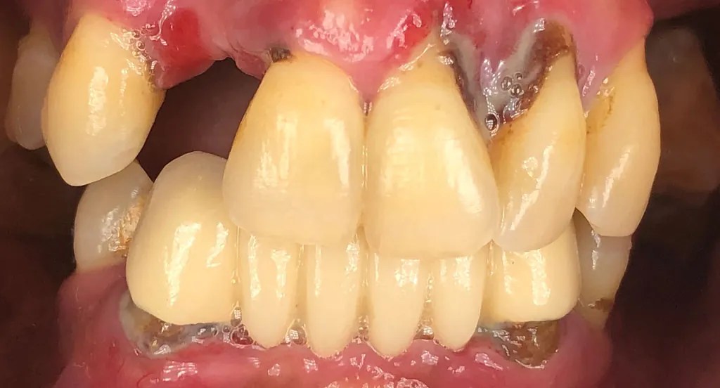 Full Arch Dental Implants Durham Dental Solutions