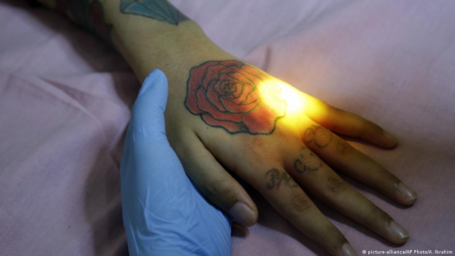 Tempat Menghilangkan Tato Permanen Di Jakarta Sederet Tempat