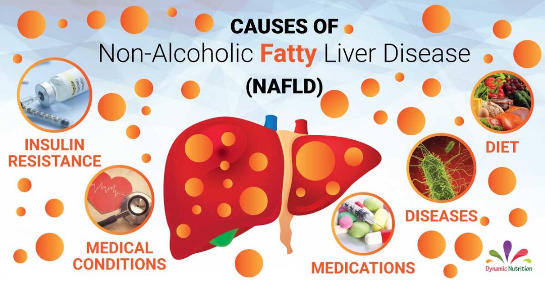 Causes of Fatty Liver (Nonalcoholic and Steatohepatitis) Dynamic