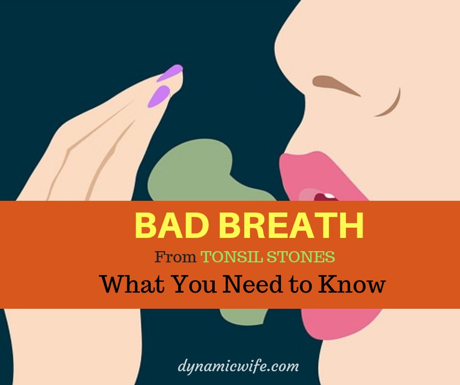 BAD Breath From Tonsil Stones Is It Curable?