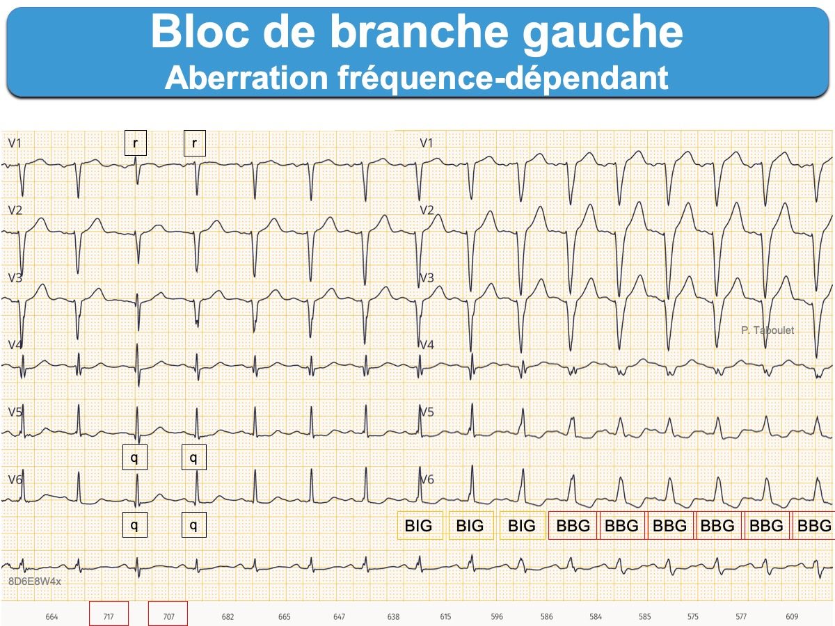 Bloc de branche 3. gauche ecardiogram