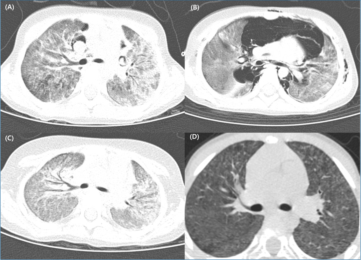 The past, present and future of humidifier disinfectantassociated