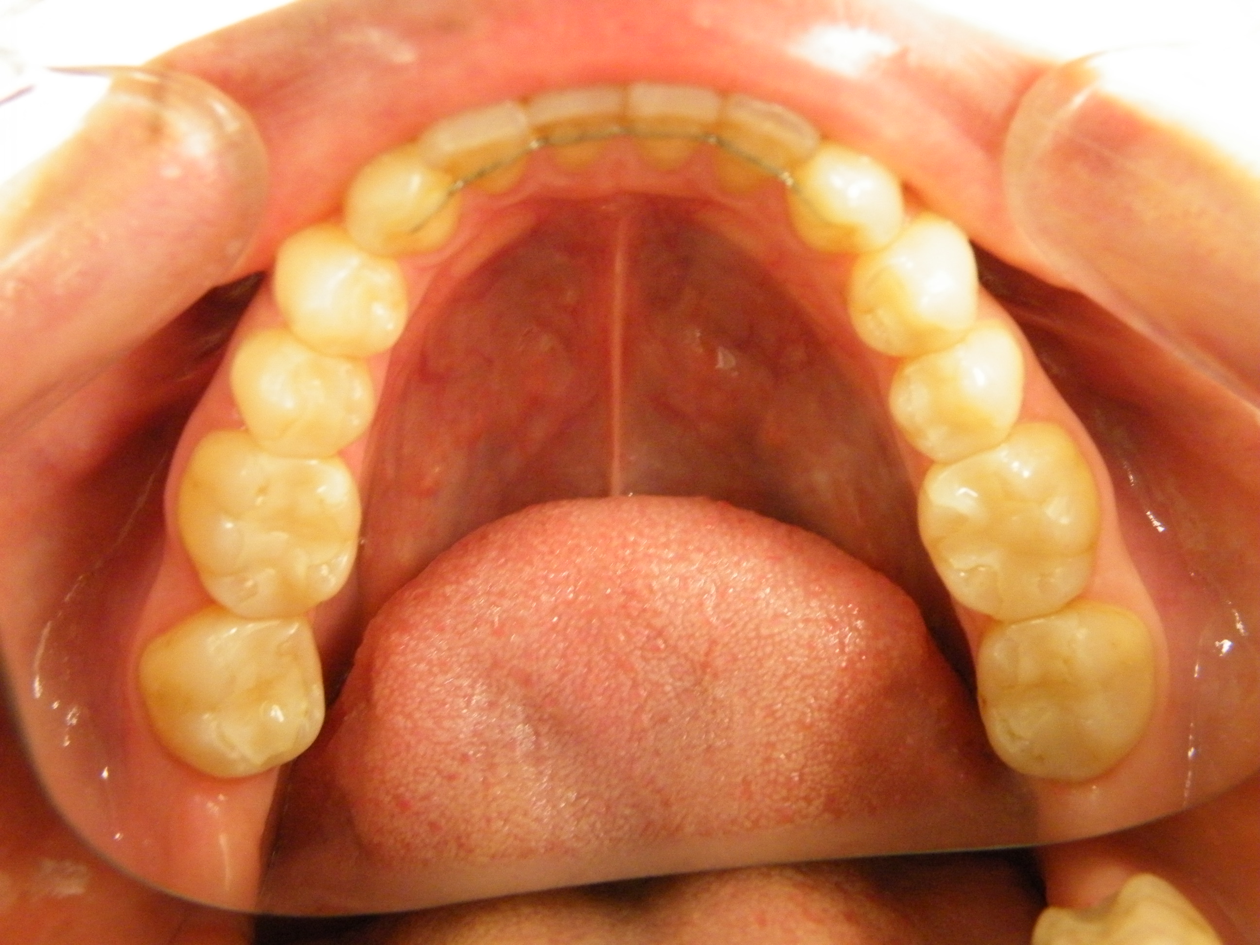 奥歯を白くしたケース ハイブリッドセラミック YOUTUBE動画見れます 大宮の歯医者｜鈴木歯科医院