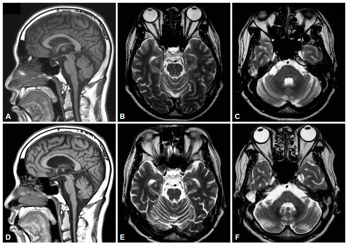A Case of Multiple System AtrophyCerebellar Type Preceded by Dementia
