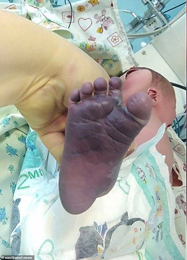 Un bébé a les deux jambes cassées lors de l’accouchement