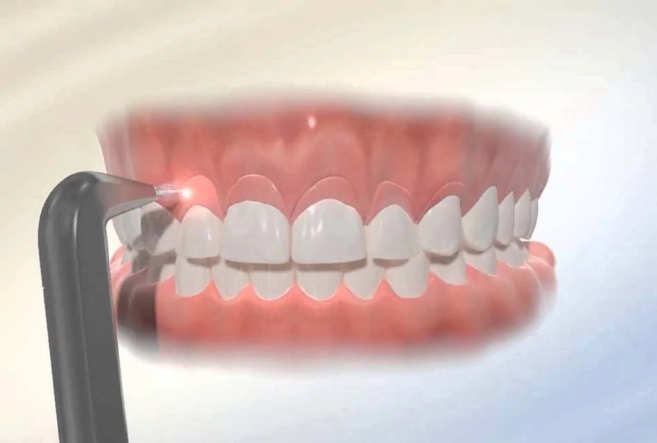 Laser Gum Removal Near Me Gingivectomy Houston