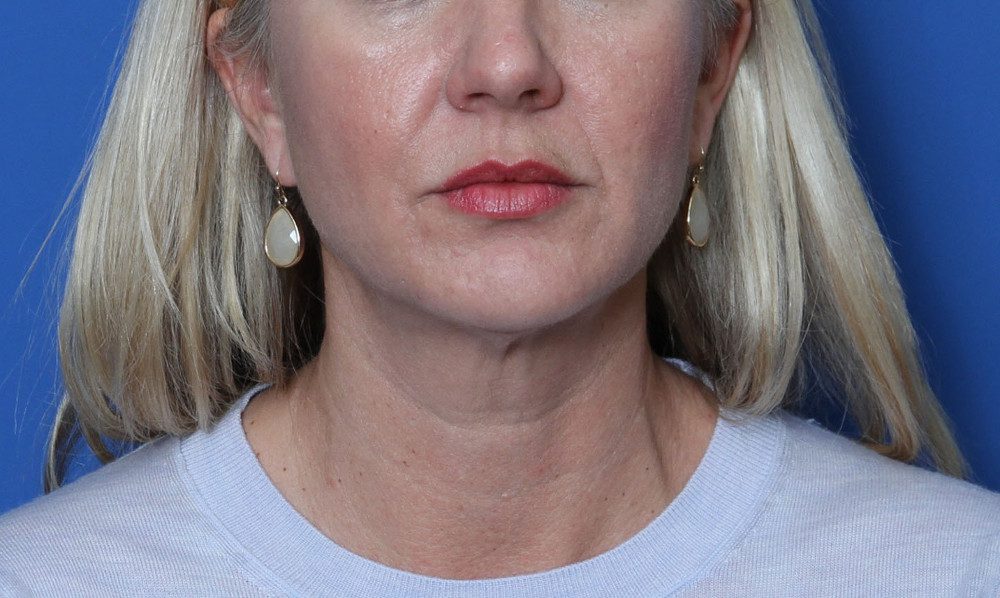 Alabama Neck Lipo Patient Photo Case 182