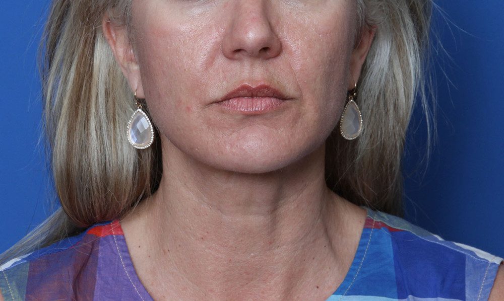 Alabama Neck Lipo Patient Photo Case 182