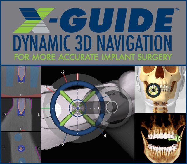 XGuide Dynamic 3D Navigation System Nacogdoches TX, Oral & Facial Surgery Group of East Texas