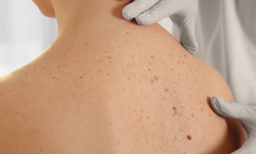Columbus Age Spot & Freckle Examination Eastside Dermatology